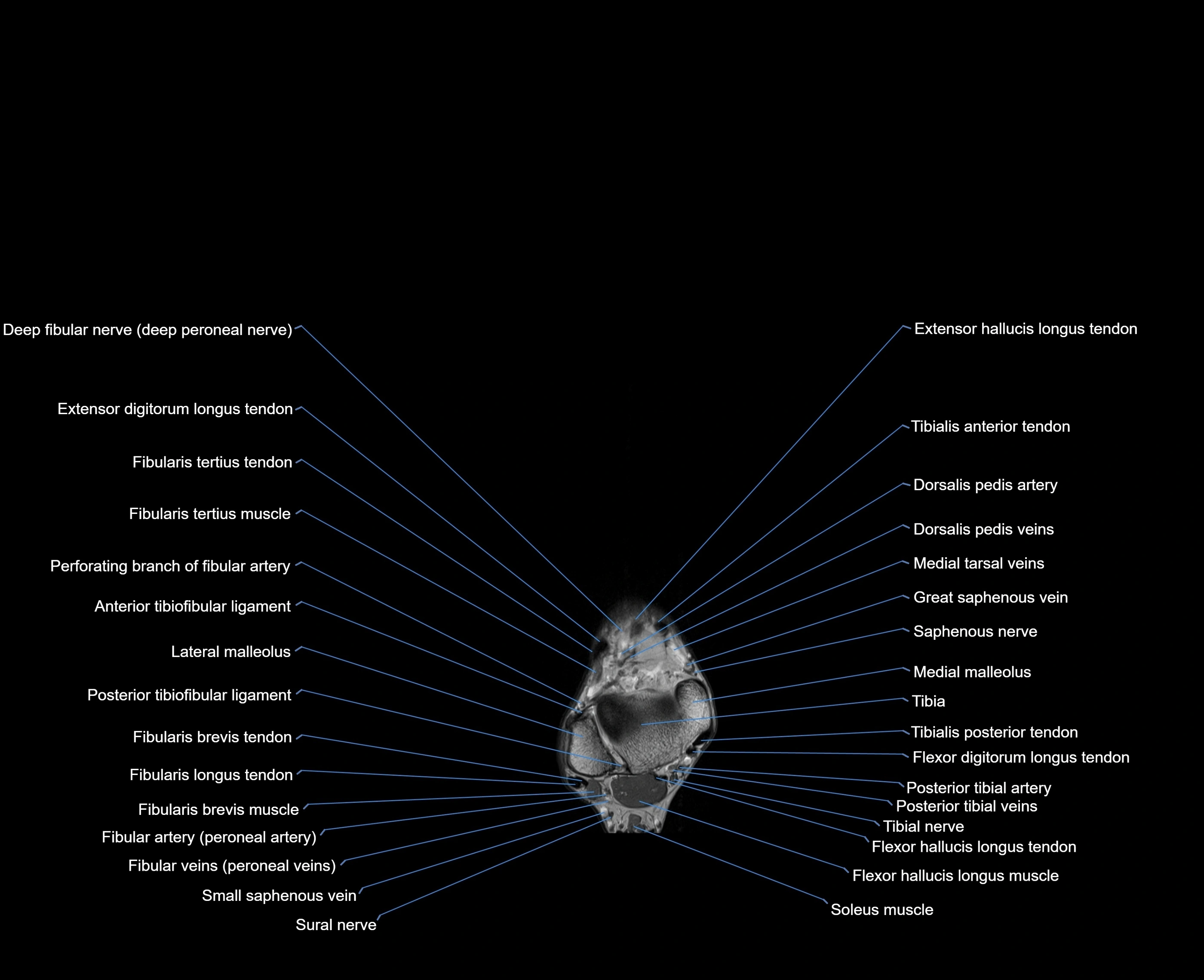 MRI foot coronal cross sectional anatomy 3T  radiology  image-img-00001-00005.webp